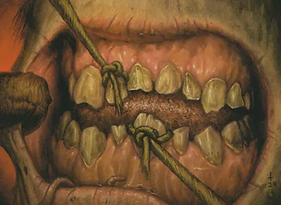 Pulling Teeth